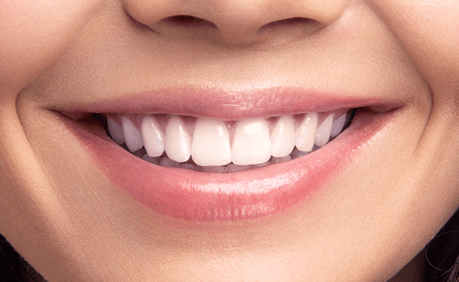 セラミック矯正