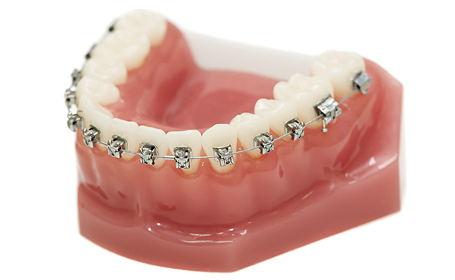 セラミック矯正